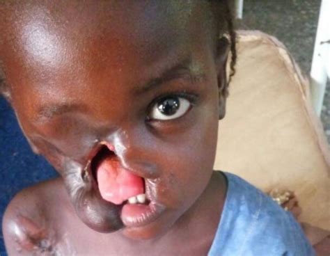 Noma Nigerian Government And Partners Mobilize To Fight The Disfiguring