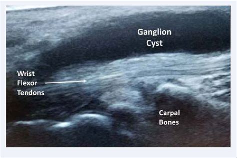 Figure From Point Of Care Musculoskeletal Ultrasound Evaluation Of An