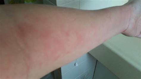 10 Serious Conditions That Rashes And Hives Can Indicate Page 9