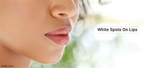 White Spots On Lips Sore Throat