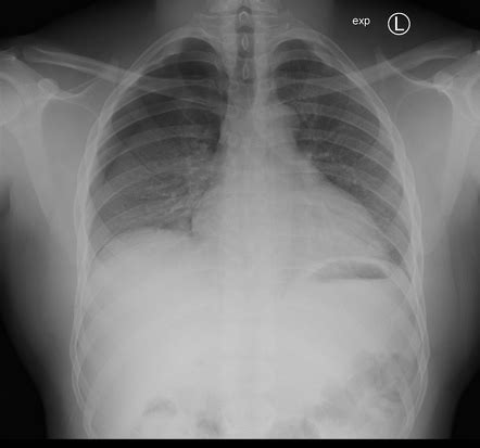 Pneumothorax On Inspiration And Expiration Chest X Rays Radiology My