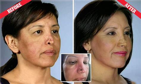 Woman Left With Gaping Hole In Her Nose Following Botched Surgery