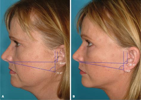 Figure 1 From Reducing The Incidence Of Ear Deformity In Facelift