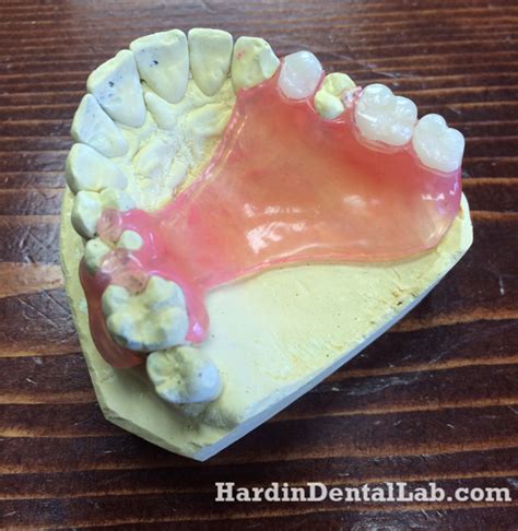 Tcs Partial Hardin Dental Lab