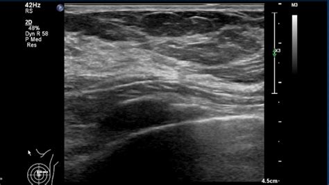 Breast Ultrasound Normal Anatomy Youtube