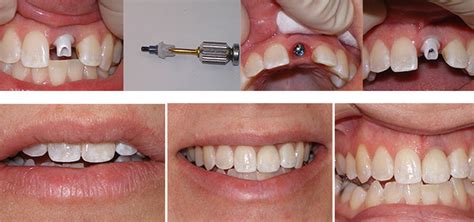 Single Tooth Dental Implant Scarsdale Dental Group