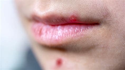 Herpes Vs Pimple