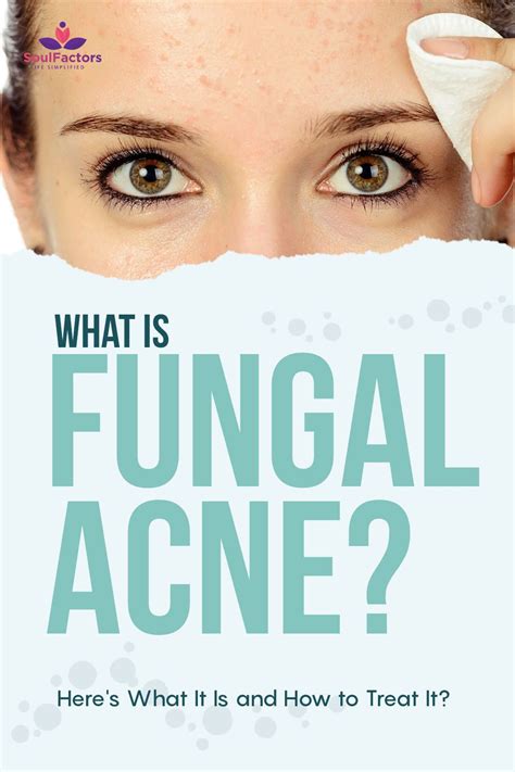 Fungal Acne Is Tricky To Diagnose And You Might Have It Artofit