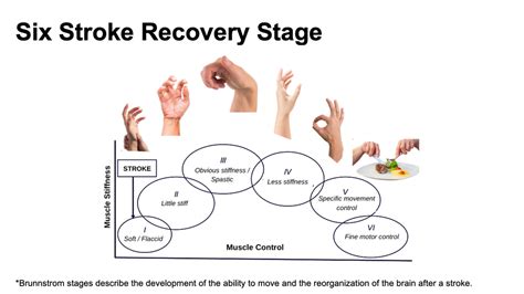 Understanding Hand Recovery After Stroke A Comprehensive Guide
