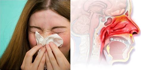 Nasal Congestion Surprising Causes And Natural Treatments Allergy Gate