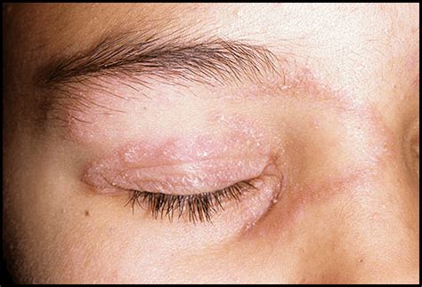 7 Causes And Effective Home Remedies To Get Rid Of Eyelid Rashes