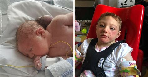 Miracle Baby Born With Brain Outside Her Head Now 3 She Has Defied