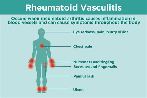What Is Rheumatoid Vasculitis Important Facts About This Ra Complication