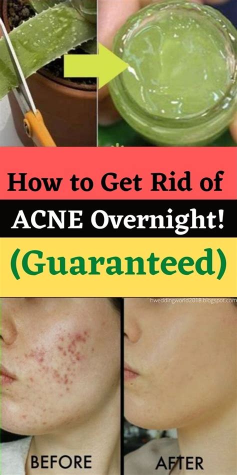 How To Get Rid Of Acne Overnight Guaranteed