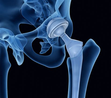 Couple Says Stryker Femoral Head Is Defective Top Class Actions