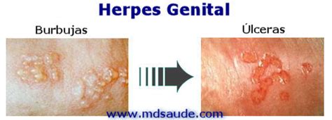 Herpes Genital Et Sexual