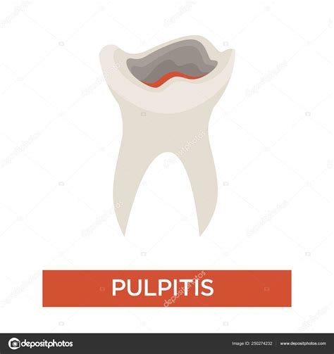 Tooth Decay Caries Stage Dentistry And Dental Health Pulpitis Stock