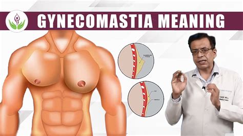 gynecomastia pictures