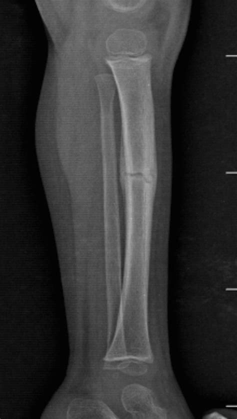 Greenstick Fracture Incomplete Fracture With Cortical Breach Of Only