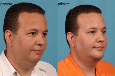 Buccal Fat Removal Before And After Pictures Case 73 Orlando Florida