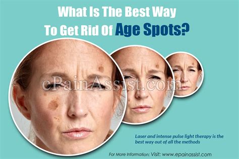What Is The Best Way To Get Rid Of Age Spots