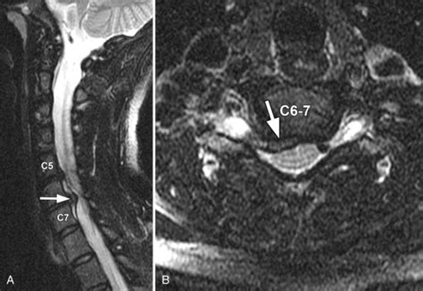 Disc Herniation And Spondylosis—cervical Radiology Key