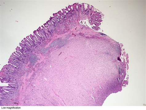 Gastric Polyp Pathology Outlines Pathology Outlines Schwannoma