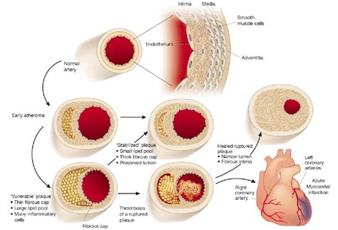 1 A Depiction Of The Progression Of Atherosclerosis Showing The