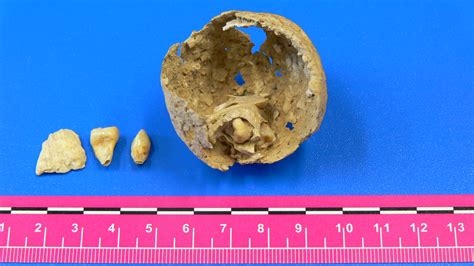 Ovarian Tumor With Teeth And A Bone Fragment Inside Found In A Roman