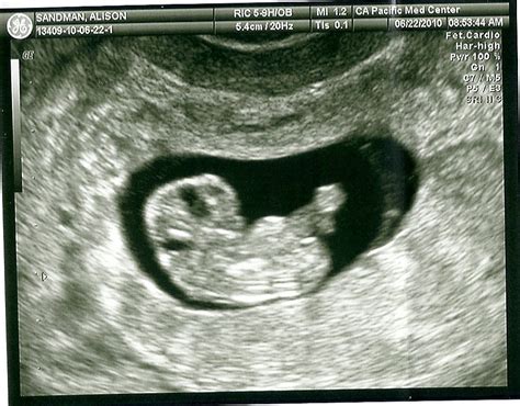 8 Weeks Pregnant Symptoms And Feelings Fetus Development