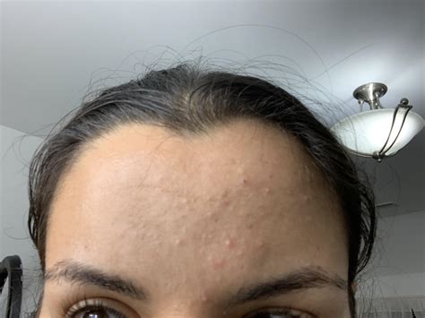 Is This Fungal Acne Also How Long Does It Take To See Results When
