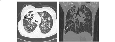 High Resolution Computed Tomography Hrct Of The Patient 1′ Lungs A