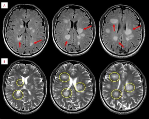 Pre Treatment Brain Magnetic Resonance Imaging Mri With And Without