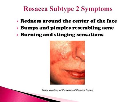 Subtypes Of Rosacea And Their Symptoms