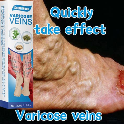 Best Seller Spot Local Delivery Ml Varicose Veins Remover Effective