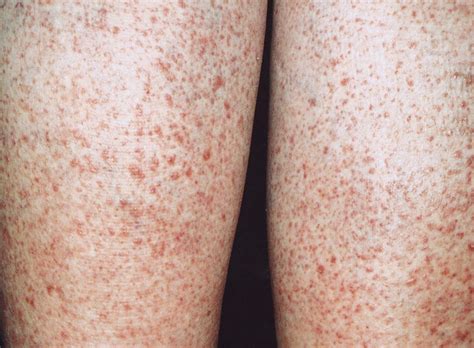 10 Dermatologic Signs Of Celiac Disease Dermatology Advisor