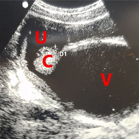 Pdf Hematocolpos Due To Imperforate Hymen A Case Report And