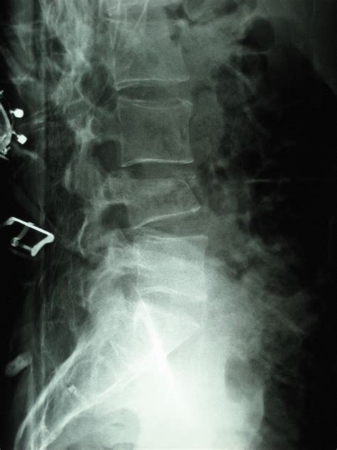 Acute Compression Fracture Lumbar Spine Prnso