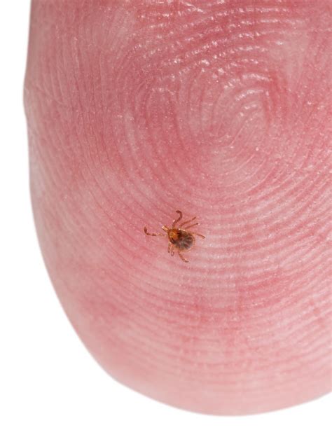 Normal Tick Bite Vs Lyme