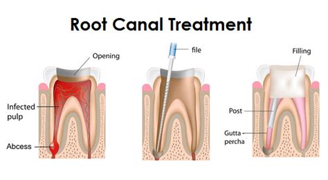 Maybe you would like to learn more about one of these? Root Canal Cause - Markham Dentist - Forestbrook Dental