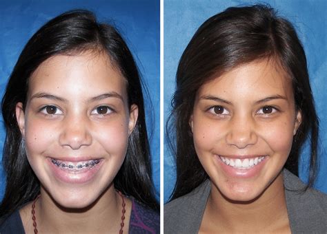 Before And After Case 13 Mandible Surgery Larry M Wolford Dmd