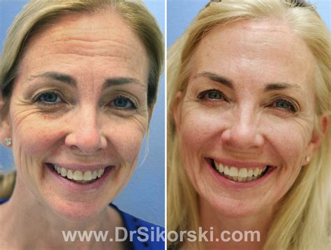 Orange County Botox Before And After Photos Natural