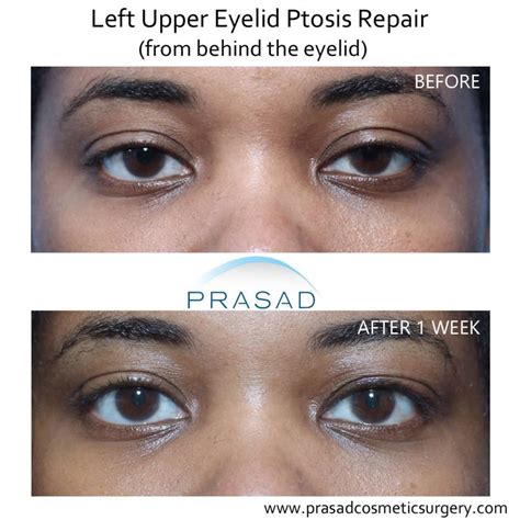 Droopy Eyelid Surgery Eyelid Ptosis Procedure And Recovery