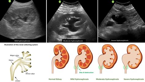 The Ultrasound Mimics Of Hydronephrosis Renal Fellow Network Urology