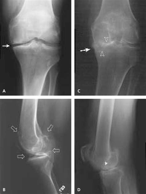 Radiographic Assessment Of Osteoarthritis Aafp
