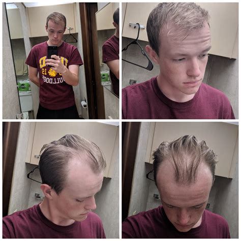 Balding At The Ripe Age Of 23 Do I Keep Attempting To Fake It Or Shave