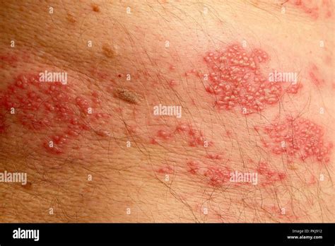 Painful Shingles Blisters On The Back Of A Man Hi Res Stock Photography