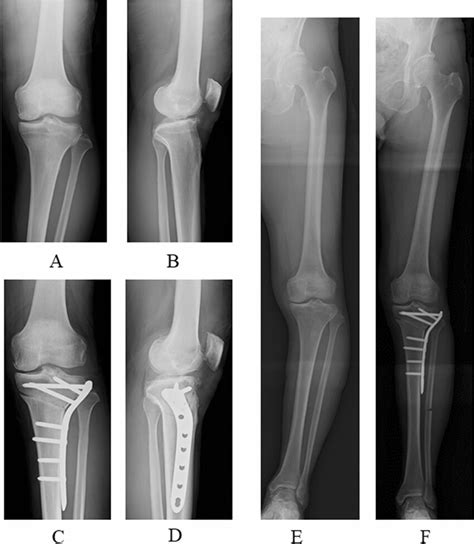 Medial Compartment Osteoarthritis Of The Left Knee Of A 71 Year Old
