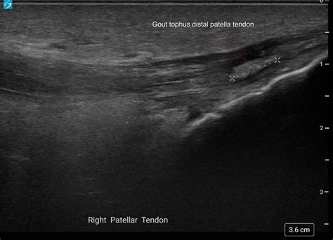 Acute Gout Of The Knee Ultrasound First