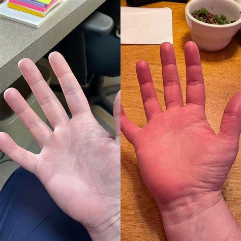 Erythromelalgia And Raynauds Both Ends Of The Spectrum Rdysautonomia